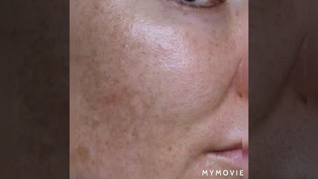 MELASMA, HYPERPIGMENTATION पाये छूटी USE कीजिए Evalite Cream смотреть онлайн