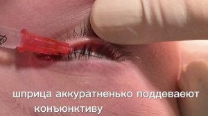 Субконъюнктивальная инъекция