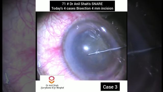 71 # Dr Anil Shah's SNARE 4 Cases of Bisection 4.0 mm incision смотреть онлайн