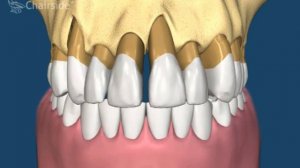 Воспаление десны вокруг зуба вид со стороны кости