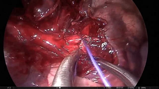 Uniportal VATS left S9+S10 segmentectomy смотреть онлайн
