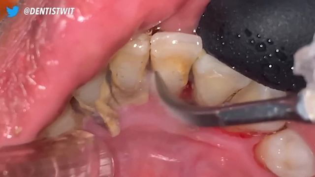 Scaling Tartar - Tartar Cleaning - Video From Asia смотреть онлайн