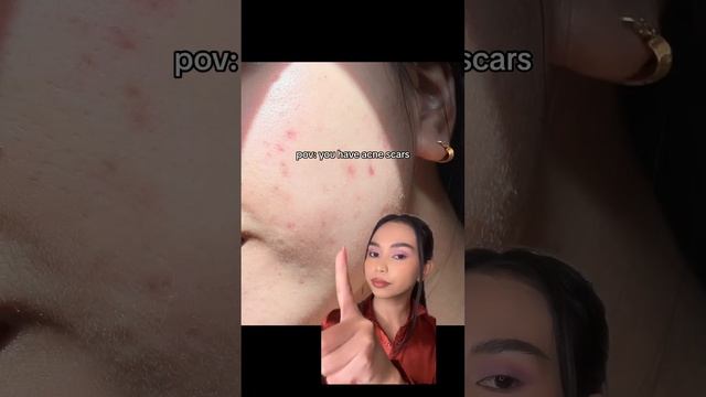 This One Might Be Too Strong For Some Skin Types So You Can Use Another Brands Azelaic Acid #acne