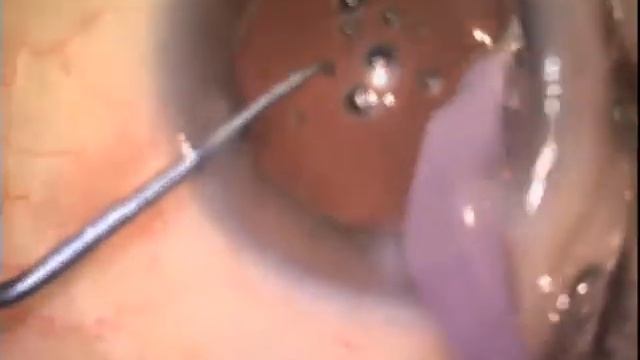 Phaco With Constellation