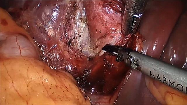 Laparoscopic Cholecystectomy Acute Cholecystitis HD смотреть онлайн