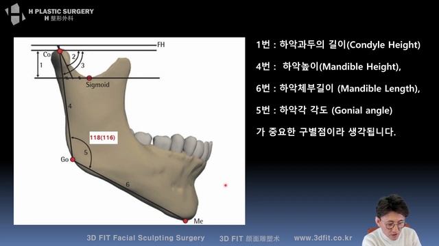 (ENG SUB) 무턱과 하악왜소증의 차이 [무턱과 하악왜소증 총정리 #1] смотреть онлайн