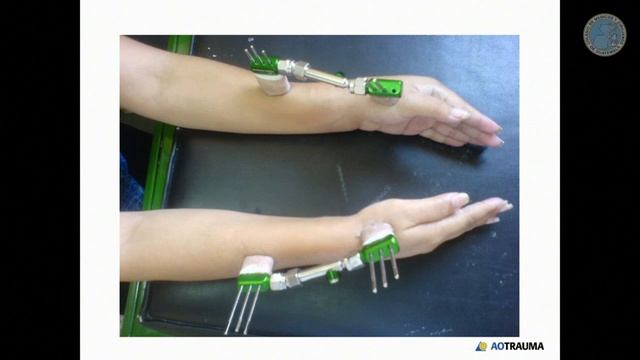 "Fractura Radial Distal" смотреть онлайн
