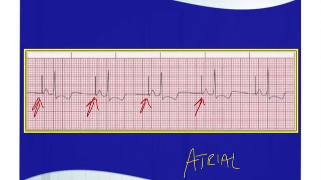 The ECG Course - Paced Rhythms смотреть онлайн