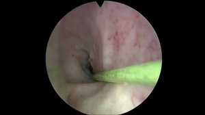 эндоскопическое лечение стриктуры уретры