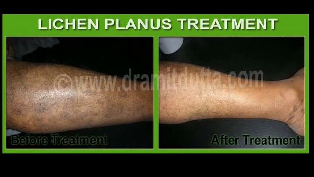 Lichen Planus , LPP , Lichen Simplex - Best Ayurvedic Treatment Centre in India смотреть онлайн