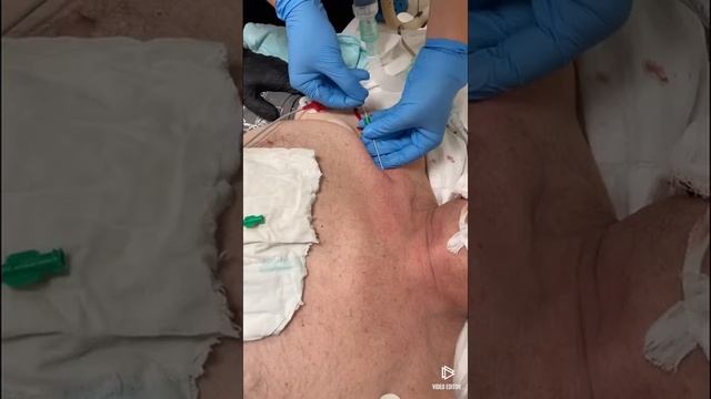 Катетеризація правої підключичної вени#11.Catheterisation vena subclavia dextra#11 смотреть онлайн