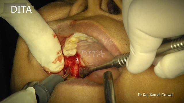 Crestal Approach (Indirect Sinus Lift) For Conventional Implant With Nova Bone Putty Graft смотреть онлайн