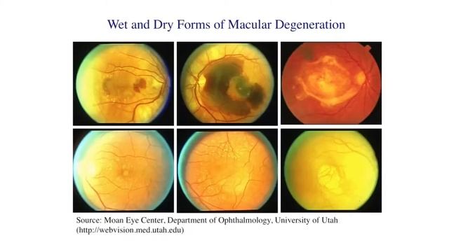 Lutein & Zeaxanthin beneficial for eye diseases - Super Lutein by Prof Khachik Part 1 смотреть онлайн
