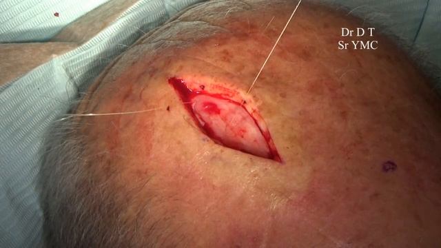 skin Cancer on the Scalp - Surgical Excision смотреть онлайн