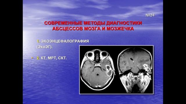 9:40 КОТЛ№6 отогенные осложнения смотреть онлайн