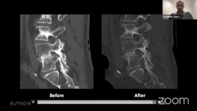 Universidad Flanc: Modulo Columna Vertebral смотреть онлайн