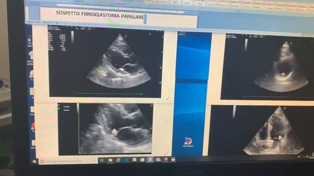 Massa sub-mitralica (Sospetto Fibroelastoma Papillare) смотреть онлайн