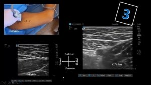 Dual Subsartorial Block | DSB| Adductor Canal Block | Femoral Triangle Block | Ultrasound