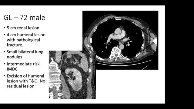315 Cytoreductive Nephrectomy Post CARMENA and SURTIME Trials. Zeeshan Aslam Ninewells Hospital, UK смотреть онлайн
