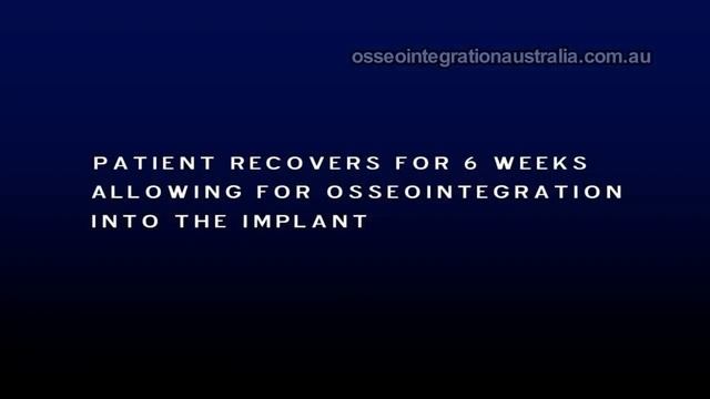 Integral Leg Prosthesis System - 3D Overview смотреть онлайн