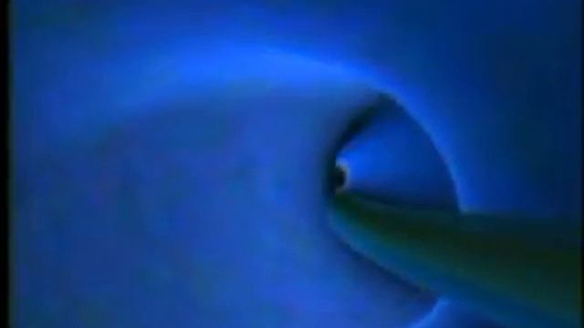 Endovenous Laser Therapy смотреть онлайн