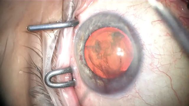 mid-fellowship trainee phaco-trabectome, high myope axl 29 mm, s/p RD смотреть онлайн