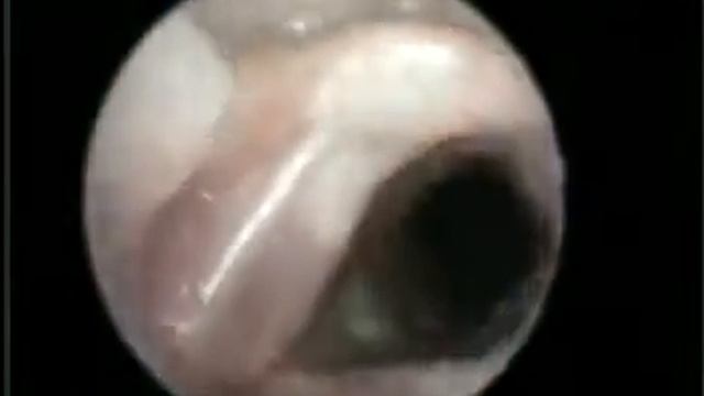 Laryngoscopy, lymphadenitis 2 смотреть онлайн