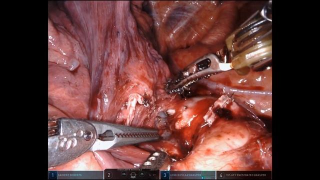 lingular sparing tri-segmentectomy of LUL - removal S1, S2 S3, with ICG navibronch and ICG of vein смотреть онлайн