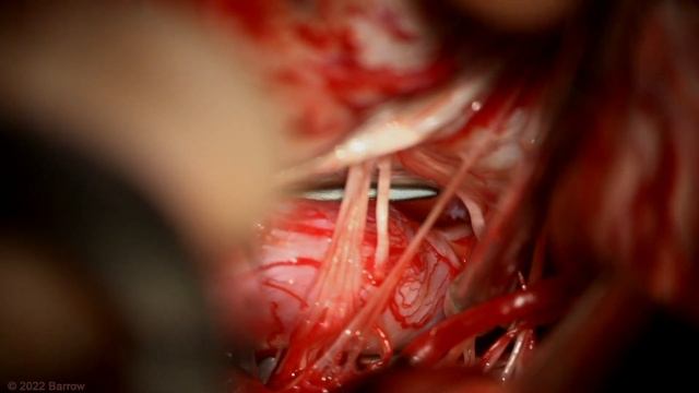 Far Lateral Craniotomy for Clip Reconstruction of a Fusiform V4 Vertebral Artery Aneurysm смотреть онлайн