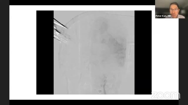 Surgery to Endovascular Therapy, New Hybrid Approaches: Carotid Cavernous Fistulas - Peter Kan, M.D смотреть онлайн