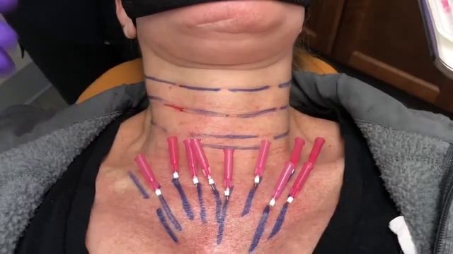 Tightening and Smoothing the Decolletage with VSoft Lift PDO Threads смотреть онлайн