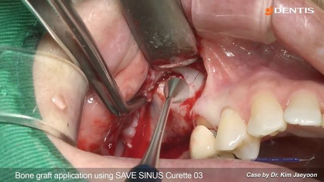 [DENTIS Implant] Posterior upper implant surgery with SQ fixture & lateral sinus lift смотреть онлайн