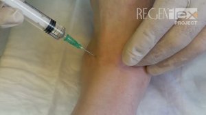 Инъекция REGENFLEX Starter в голеностопный сустав