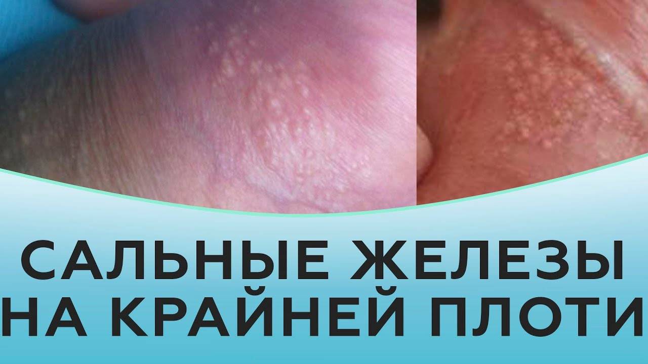 Сальные железы на крайней плоти смотреть онлайн