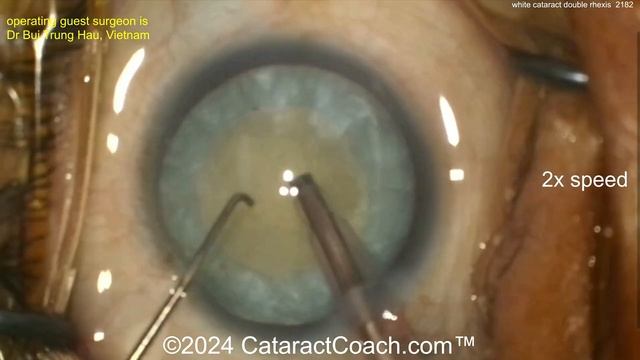 CataractCoach™ 2182: white cataract double rhexis technique смотреть онлайн