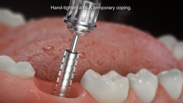 Straumann® BLX Immediate Molar Placement
