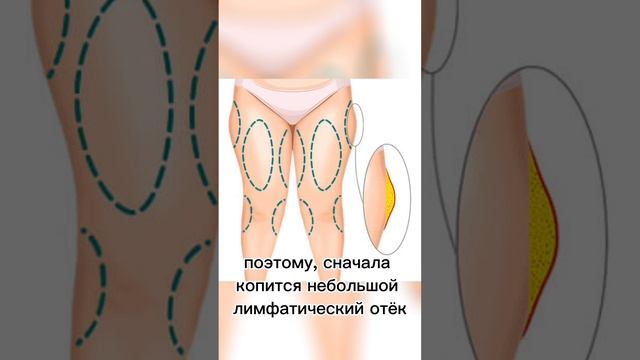 Целлюлит? Ушки на бедрах? Реальные причины! смотреть онлайн