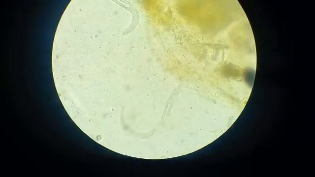 strongyloides stercoralis larvae смотреть онлайн