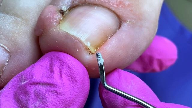 Вросший ноготь - воспалился палец! (Часть 2) Результат спустя 6 месяцев #подолог #подология смотреть онлайн