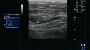 PECS 1 AND Serratus Anterior Plane (SAP) BLOCK