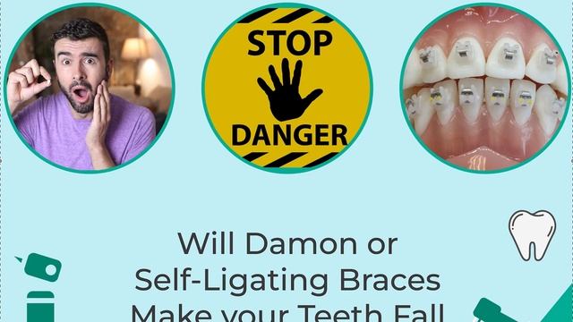 Will Damon or Self- Ligating Brackets Make your Teeth Fall Out? смотреть онлайн