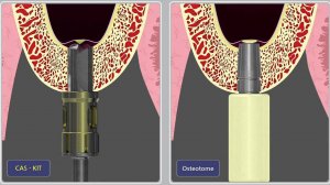 Закрытый синус-лифтинг. CAS KIT vs. Osteotome