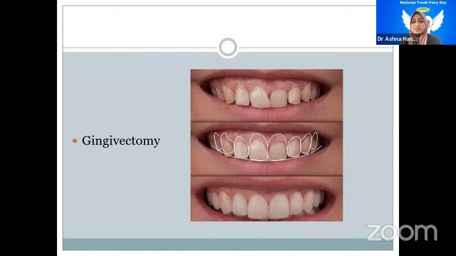 Webinar on "Shining Teeth for Smiling Face" смотреть онлайн