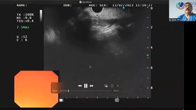 Linear EUS evaluation of A-P window: A simpler method смотреть онлайн