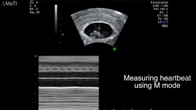 Baby Ultrasound early pregnancy 5,6,7,8,9 weeks 3D смотреть онлайн