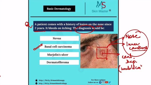 2 MINUTES DERMATOLOGY : BASAL CELL CARCINOMA смотреть онлайн