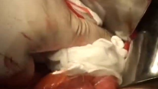 PerClot Abdominal Surgery Video HR ML0459 000 смотреть онлайн
