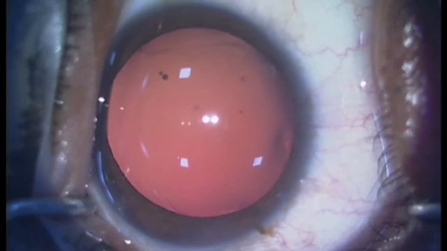 Phakic Intraocular Lens (pIOL) In Cases Of High Myopia - Supplementary Video [ID 270690]