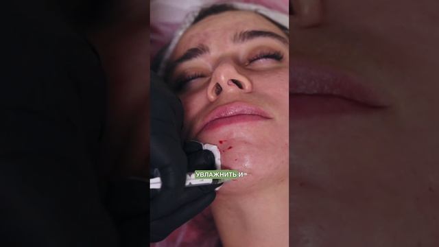 Уколы от морщин и дряблой кожи на шее помогают или нет #дряблаякожа #шея #омоложение смотреть онлайн