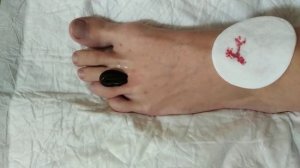Пиявка медицинская. Постановка на стопу для оздоровления и снятия боли в суставе